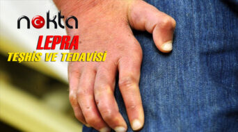 Lepranın erken teşhis ve tedavisi uzuv kayıplarını önlüyor